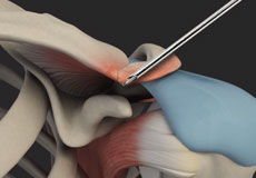 AC Joint Stabilization