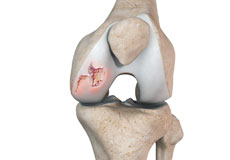Chondral or Articular Cartilage Defects
