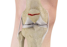 Patella Fracture