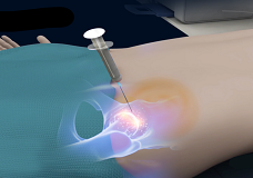 Orthobiologics for the Hip