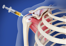 Orthobiologics Treatment for Shoulder