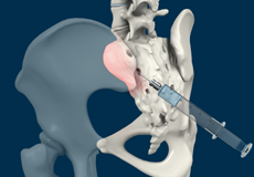 Peripheral Joint Injections